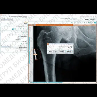 Программное обеспечение для хирургии тазобедренного сустава Hip Arthroplasty