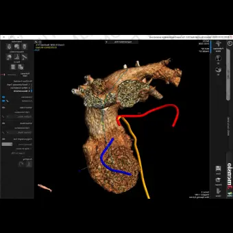 Анатомическое программное обеспечение 3mensio Pulmonary valve