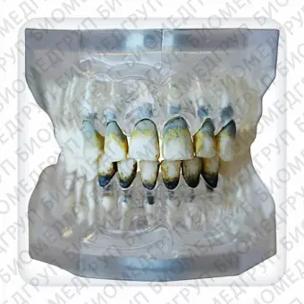 Модель верхней и нижней челюстей с 28 модельными зубами для лечения пародонтоза
