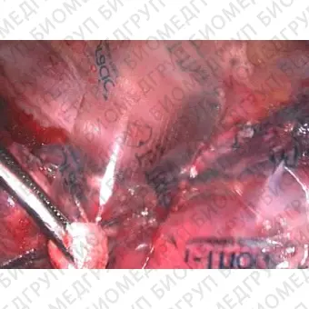 Тканевая матрица торакальная хирургия TissuePatch