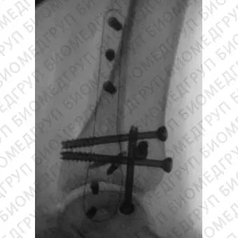 Компрессионная костная пластина малоберцовая кость CarboFix Piccolo