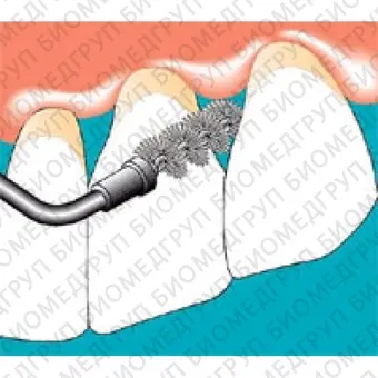 Sonicflex clean A  набор насадок и щетки Sono для профессиональной механической чистки зубов снятия зубных отложений