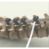 Педиатрическое спинномозговое крепление для задней фиксации Ortholox® UHMWPE