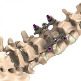 Система остеосинтеза для поясничной зоны I SHAPED